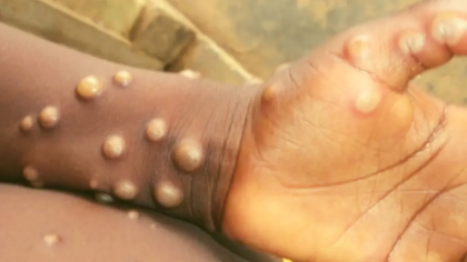 Monkeypox का खतरा समलैंगिक पुरूषों में सबसे ज्यादा, WHO ने किया दावा