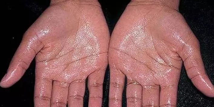 Wet Hands Disease: क्या आपके भी हाथ में आता है पसीना, जानिए क्या है इसकी वजह ?